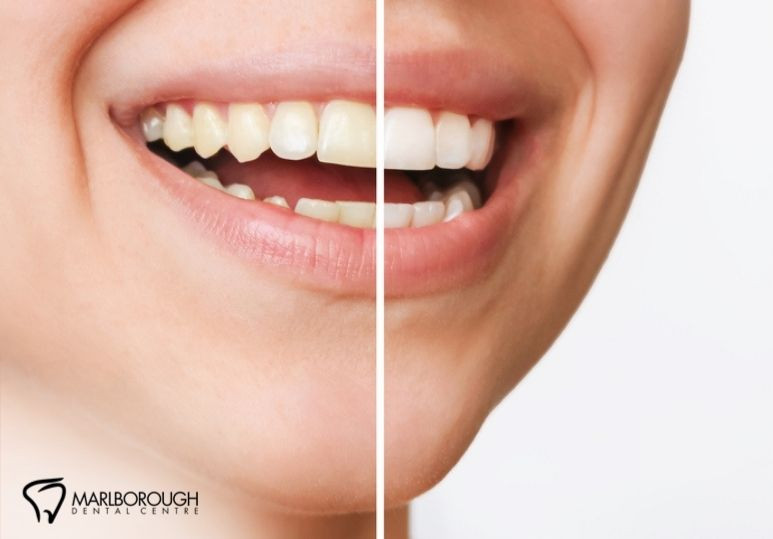 How Long Does Teeth Whitening Last? Tips for Maintaining Your Bright Smile